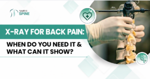 X-Ray for Back Pain