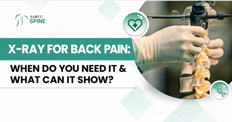 X-Ray for Back Pain